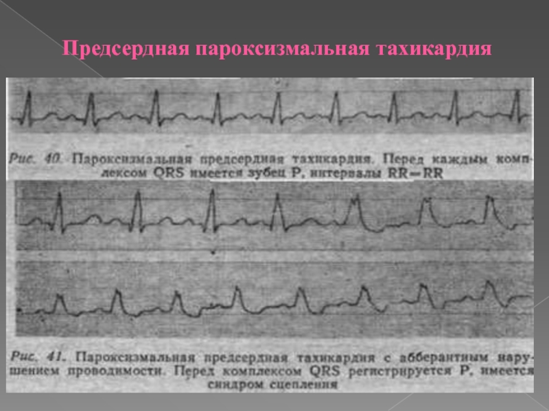 Предсердная тахикардия. Предсердная пароксизмальная тахикардия на ЭКГ. Пароксизм предсердной тахикардии на ЭКГ. Изменения ЭКГ, характерные предсердной тахикардии. Предсердная тахикардия на ЭКГ признаки.