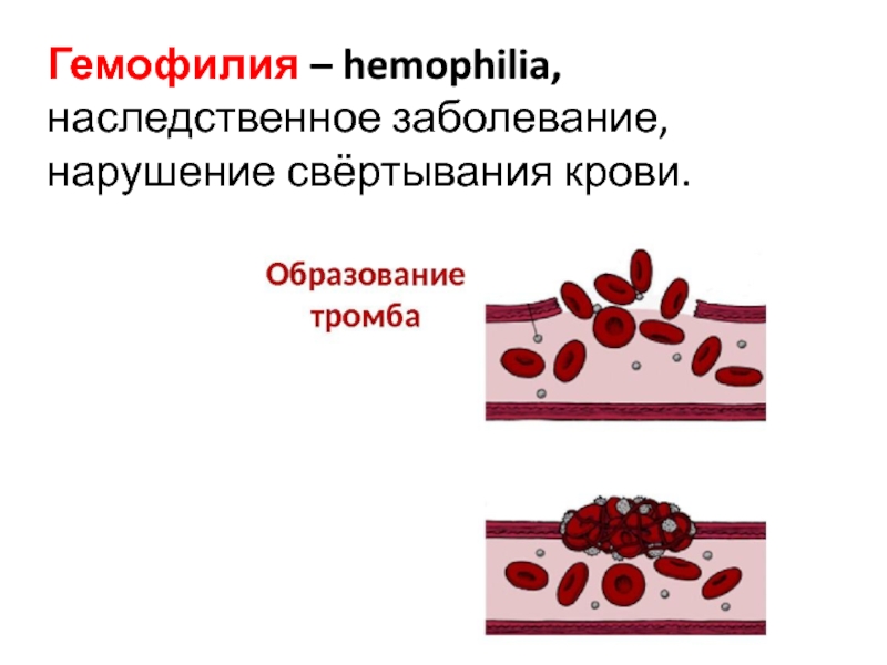 Заболевание гемофилия