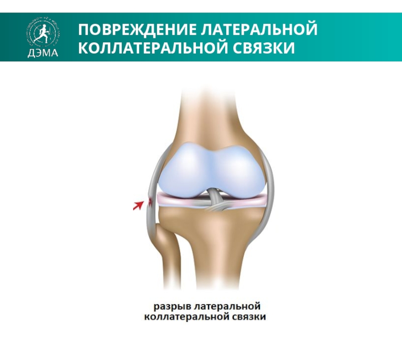 Латеральный разрыв. Повреждение боковых связок коленного сустава. Травмы боковых связок коленного сустава. Перерастяжение связок коленного сустава. Задняя крестообразная связка коленного сустава анатомия.