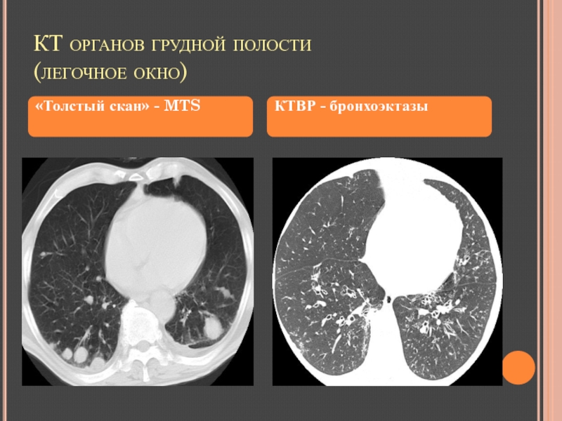 Мягкотканное образование в легком на кт. Легочное окно. Мягкотканное окно на кт. Окна кт. Костное окно на кт.