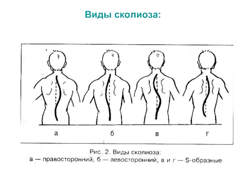 Сколиоз таблица