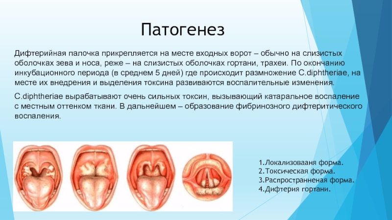 Дифтерия носа клиника