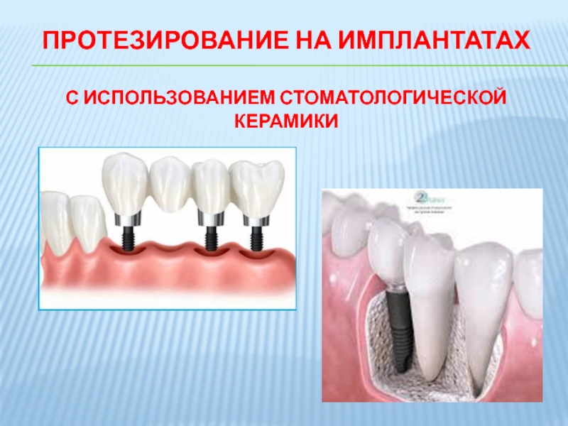 Презентация керамика в стоматологии