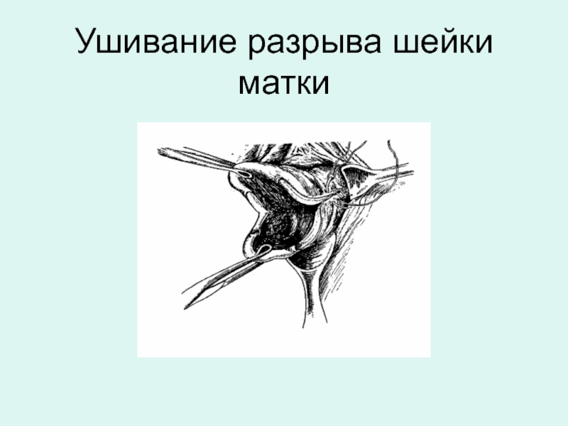 Швы шейках. Ушивание разрывов мягких тканей родовых путей. Ушивание разрыва шейки.