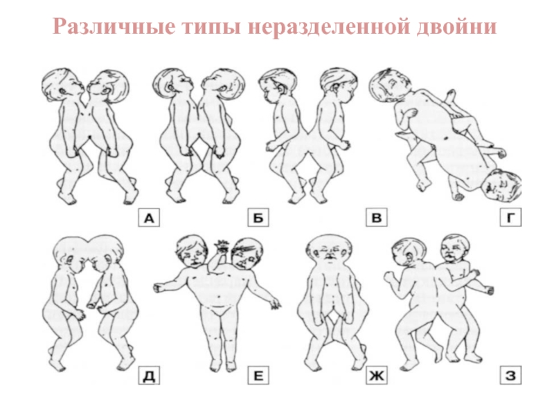 Виды близнецов схема