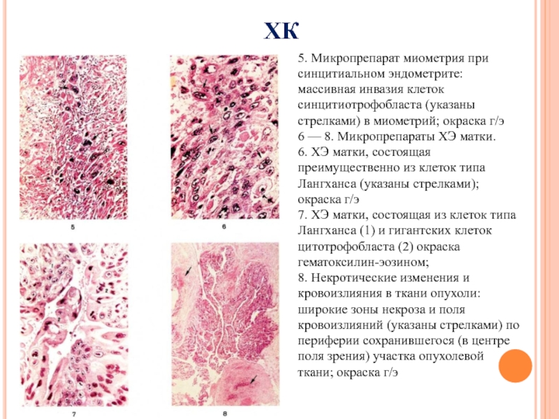 ХК 5. Микропрепарат миометрия при синцитиальном эндометрите: массивная инвазия клеток синцитиотрофобласта (указаны стрелками) в миометрий; окраска г/э6