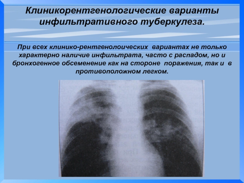Фаза распада легких. 1. Инфильтративный туберкулез. Инфильтративная форма туберкулеза рентген. Инфильтративный туберкулез с распадом рентген. Инфильтративный туберкулез в фазе инфильтрации рентген.