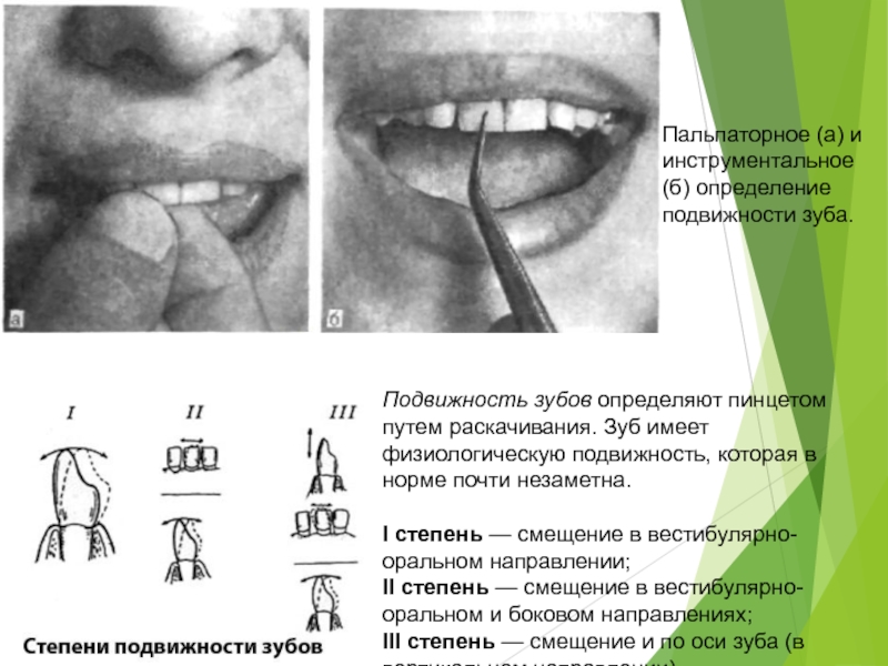 Подвижность зубов презентация