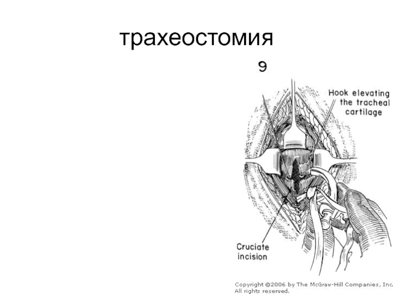 Ошибки трахеостомии