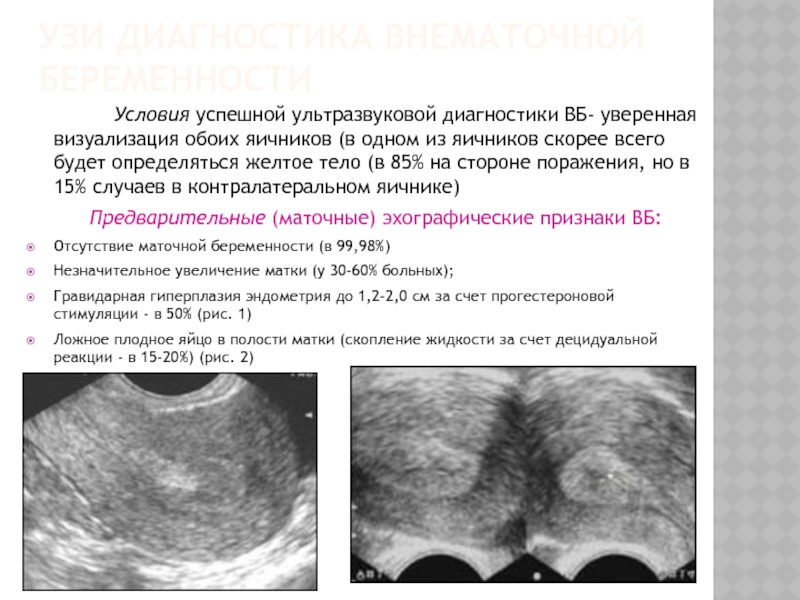 Условия беременности. Внематочная беременность на УЗИ. Внематочная беременность УЗИ заключение. Заключение УЗИ при внематочной беременности. Внематочная беременность по УЗИ.