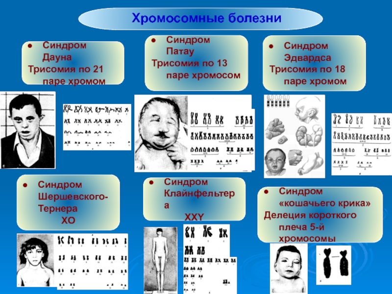 Хромосомные синдромы. Трисомия 23 пары хромосом. Трисомия по 23 хромосоме. Синдром Дауна трисомия про21 паре хромосы. Хромосомные болезни синдром Патау.