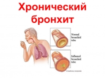 Хронический бронхит