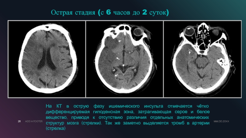 Ишемические изменения головного мозга. Ишемический инсульт мозга на кт. Ишемический инсульт снимок кт. Ишемический инсульт на кт головного мозга. Стадии ишемического инсульта на кт.