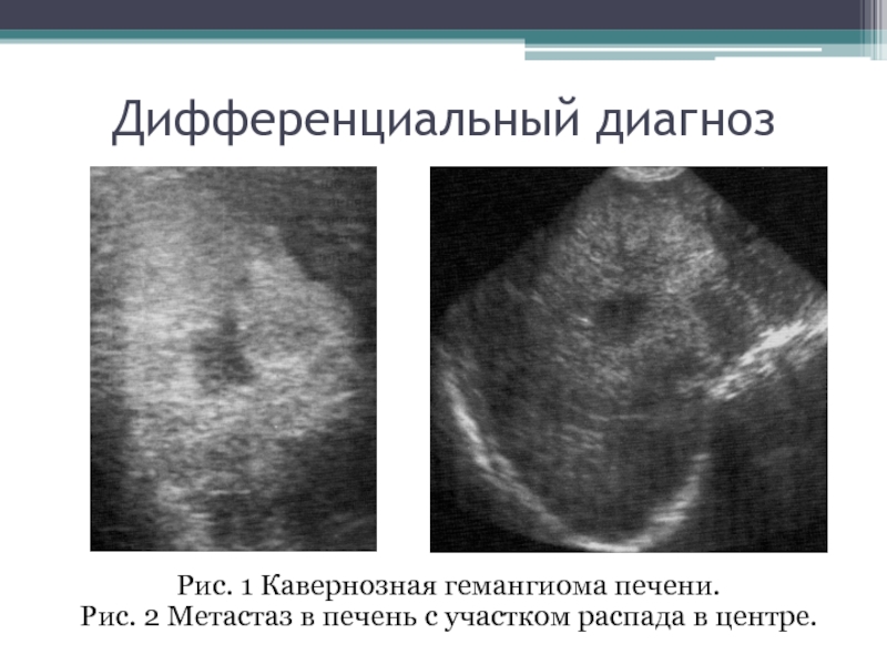 Как выглядят метастазы на узи фото