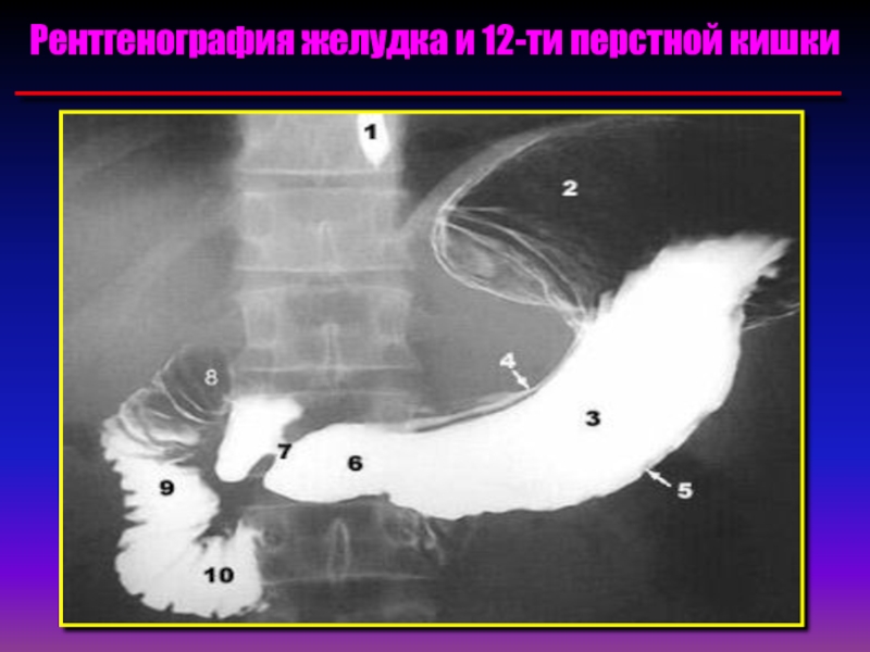 Язва 12 ти. Пилорический отдел желудка рентген. Стеноз двенадцатиперстной кишки рентген. Луковица 12 перстной кишки рентген. Рентгеноскопия желудка и 12 перстной кишки.