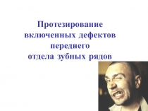 Протезирование включенных дефектов переднего отдела зубных рядов 
