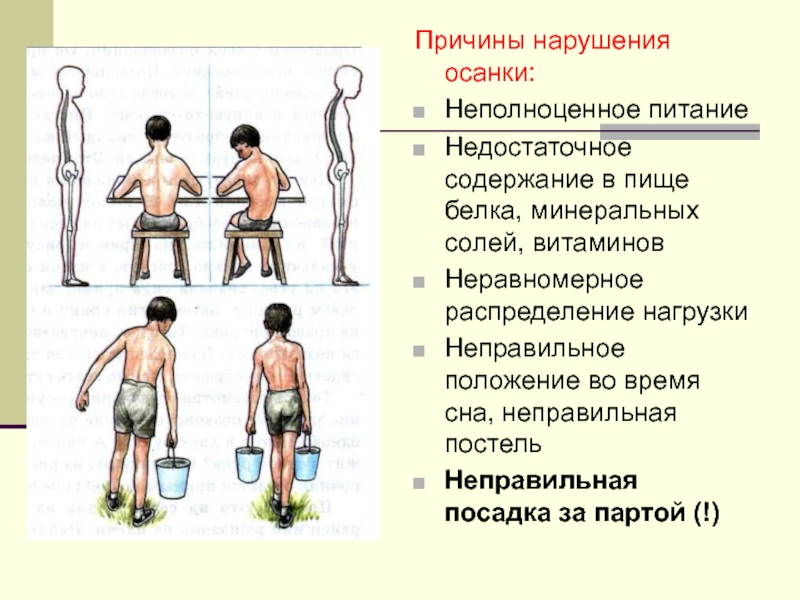 Презентация нарушение осанки