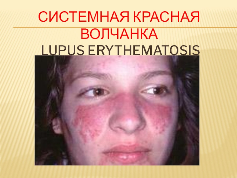 СИСТЕМНАЯ КРАСНАЯ ВОЛЧАНКА lupus erythematosis