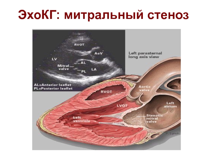 Митральный стеноз. Митральный стеноз эхокардиография. Эхокардиография при митральном стенозе. Эхокардиография стеноз митрального клапана. Эхокардиография при митральных пороках.