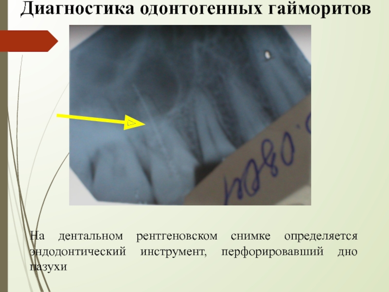 Одонтогенный синусит презентация