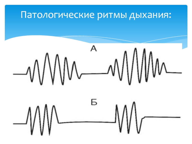 Патологическое дыхание рисунок