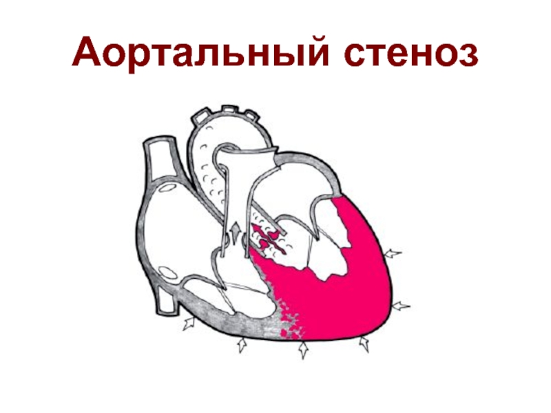 Презентация на тему Синдромы при заболеваниях сердечнососудистой системы