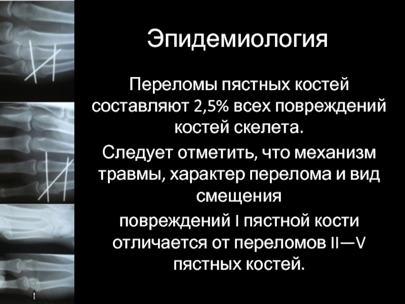 Механизм перелома 5 пястной кости. Перелом 5 пястной кости механизм травмы. Механизм травмы костного скелета. Перелом пястных костей по мкб 10 костей.