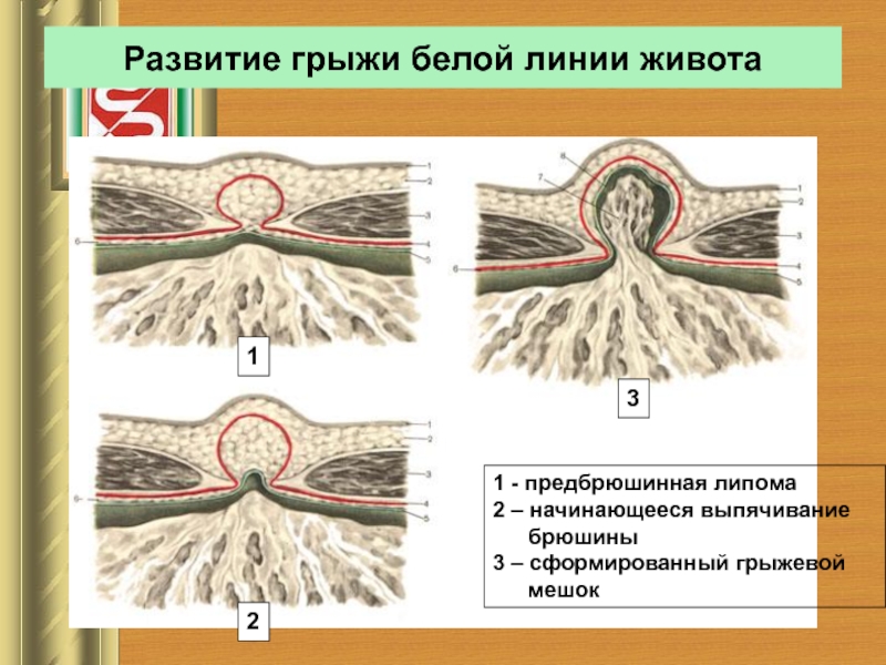 Ущемленная грыжа белой линии живота карта вызова