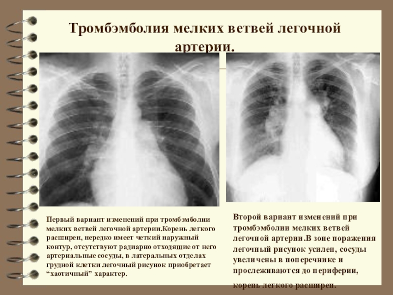 Легочный рисунок обогащен что это