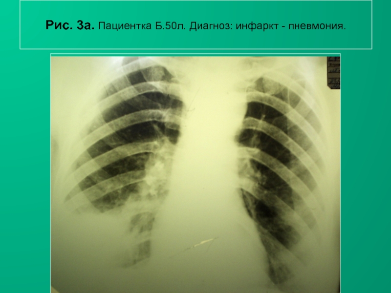 Н.С. Воротынцева, С.С. Гольев РентгенопульмонологияРис. 3а. Пациентка Б.50л. Диагноз: инфаркт - пневмония.