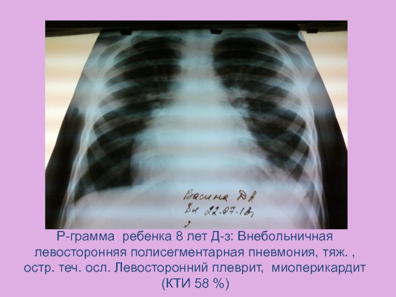 Полисегментарная пневмония. Левосторонняя полисегментарная плевропневмония рентген. Рентген легких полисегментарная пневмония. Внебольничная правосторонняя полисегментарная пневмония. Внебольничная левосторонняя полисегментарная пневмония.