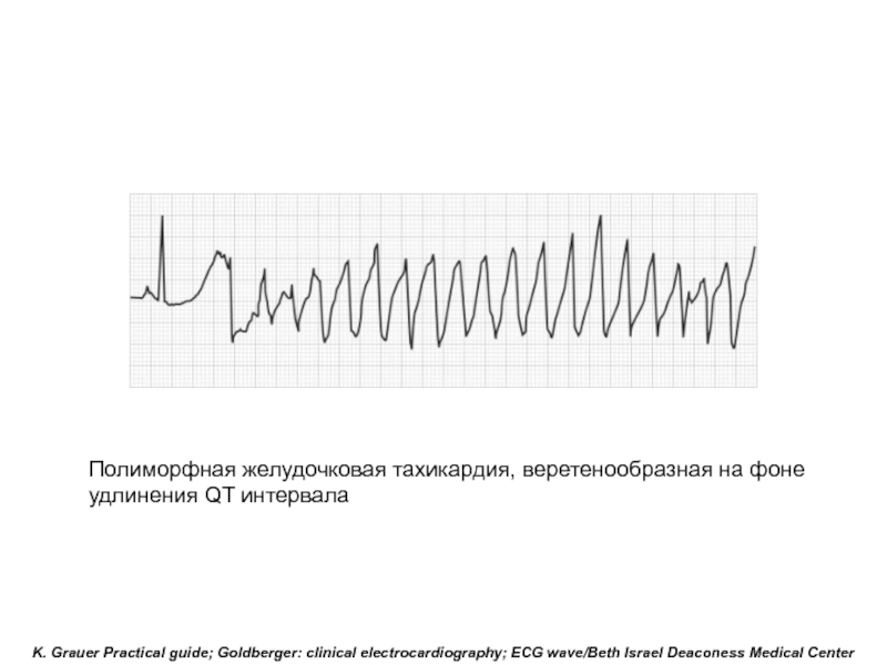 Желудочковая тахикардия. Веретенообразная желудочковая тахикардия ЭКГ. Полиморфная веретенообразная желудочковая тахикардия на ЭКГ. Веретенообразная тахикардия ЭКГ. Полиморфная тахикардия ЭКГ.