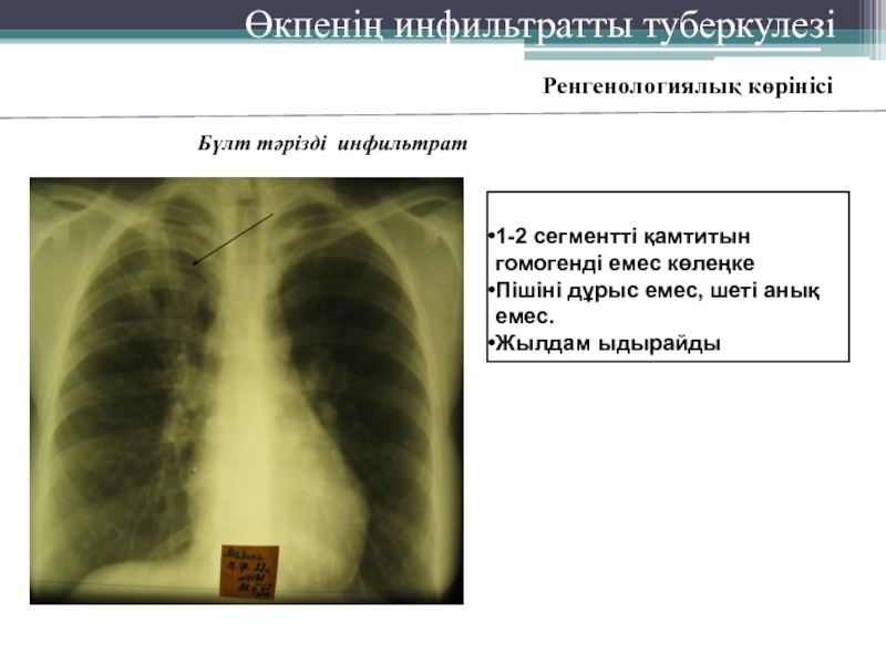 2 инфильтрат