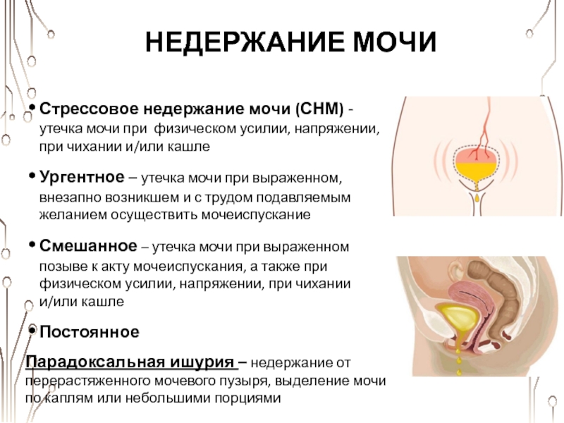 Недержание мочи у женщин причины. Стрессовое недержание мочи. Стрессовое и ургентное недержание мочи. Подтекает моча у женщин. Стрессовая инконтиненция мочи.