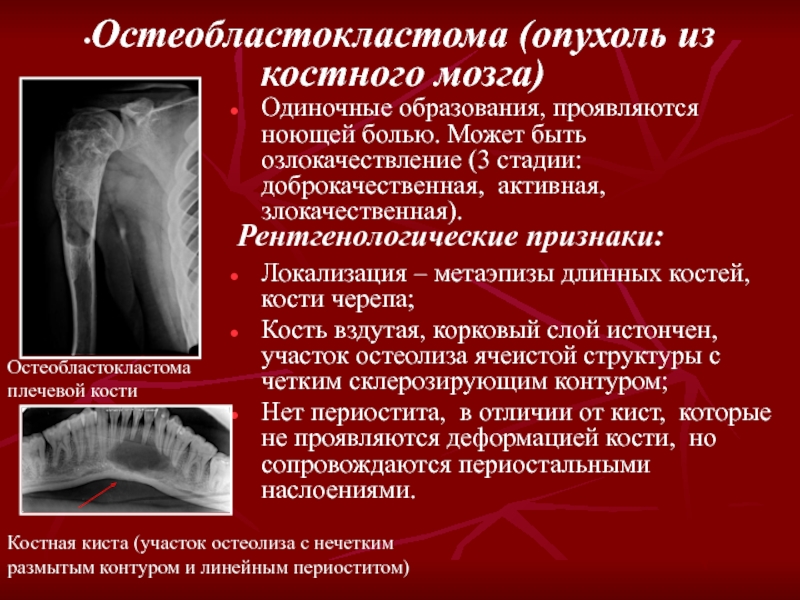 Доброкачественные опухоли костей презентация