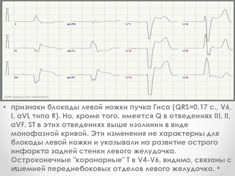 Полная блокада левой ножки карта вызова