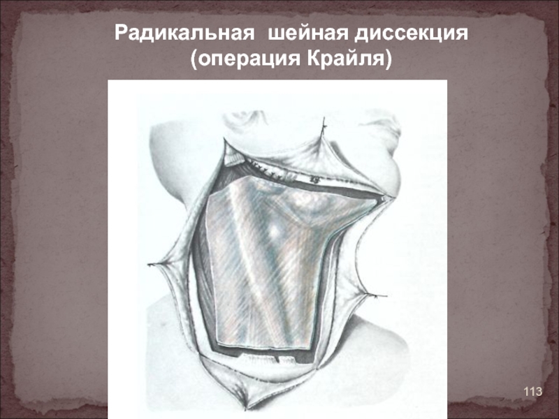 Шейная лимфаденэктомия операция Крайля. Радикальная шейная диссекция. Операция Крайля ход операции.