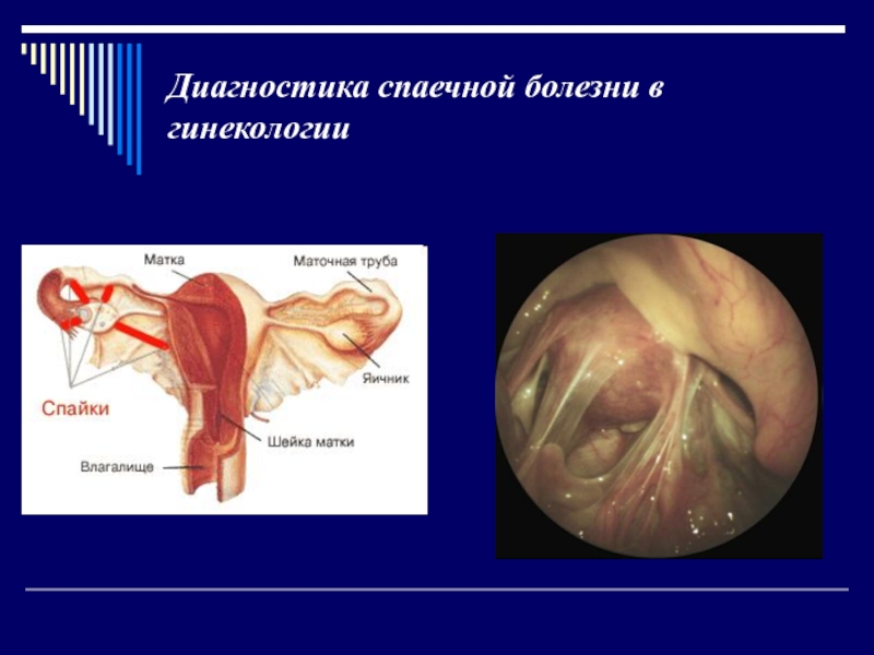 Реферат: Спаечная болезнь