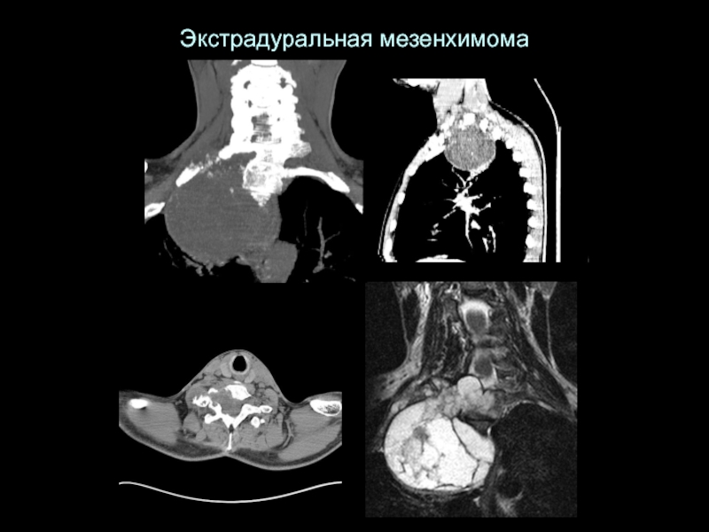 Опухоли спинного мозга презентация