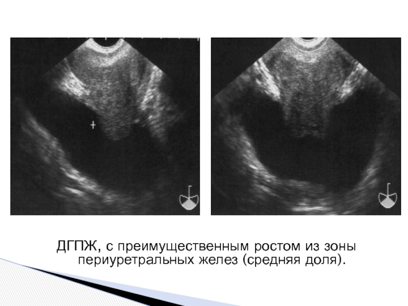 Дгпж узи. Зональная анатомия предстательной железы УЗИ. Гиперплазия предстательной железы УЗИ. Доброкачественная гиперплазия предстательной железы.