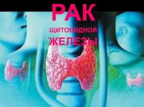 РАК
ЩИТОВИДНОЙ
ЖЕЛЕЗЫ