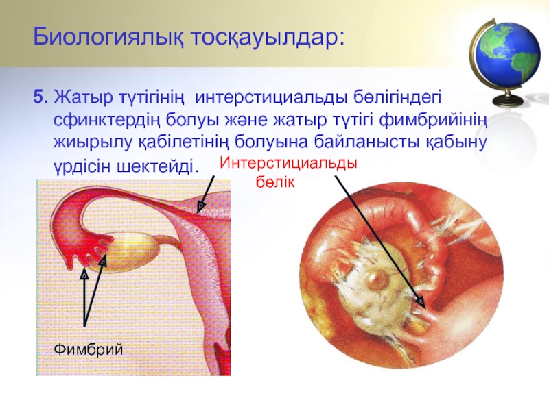 Биологиялық тосқауылдар:5. Жатыр түтігінің интерстициальды бөлігіндегі сфинктердің болуы және жатыр түтігі фимбрийінің жиырылу қабілетінің болуына байланысты қабыну