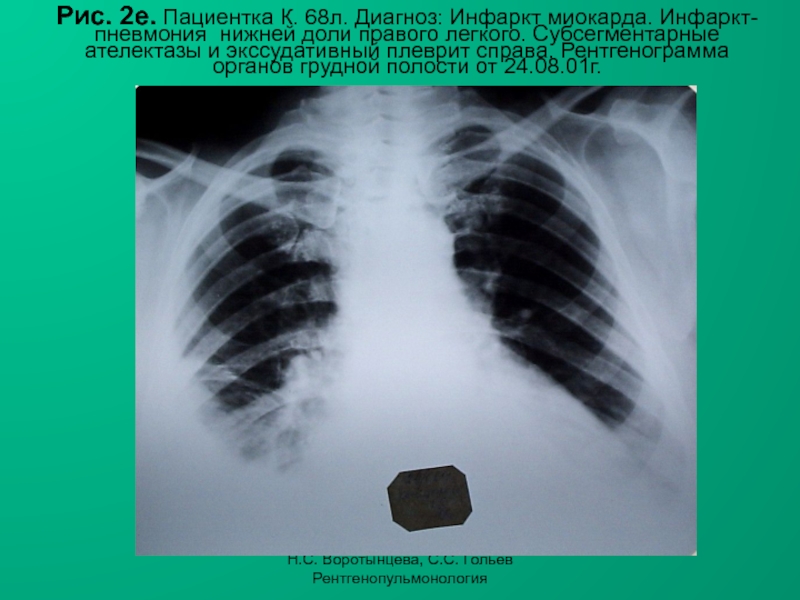 Н.С. Воротынцева, С.С. Гольев РентгенопульмонологияРис. 2е. Пациентка К. 68л. Диагноз: Инфаркт миокарда. Инфаркт-пневмония нижней доли правого легкого.