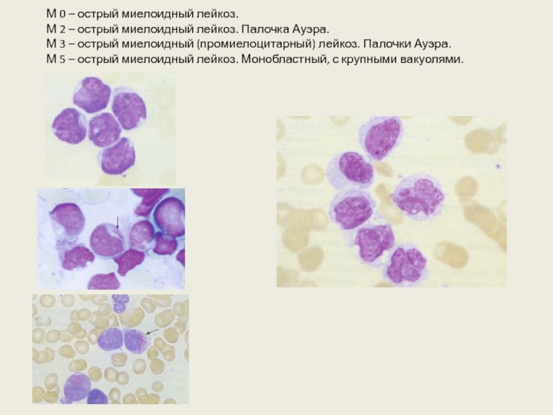 Острый миелоидный лейкоз тесты нмо. Острый промиелоцитарный лейкоз м3. Острый миелоидный лейкоз м0. Палочки Ауэра в бластах.