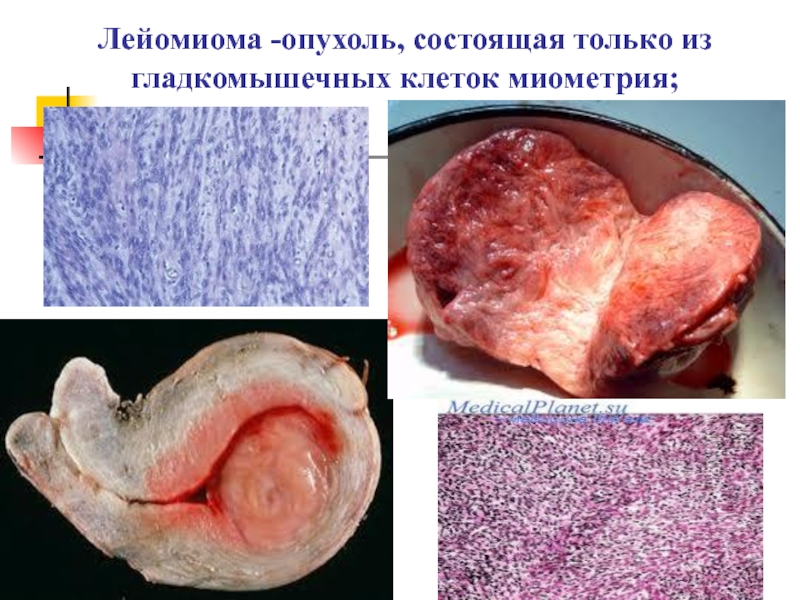Лейомиома -опухоль, состоящая только из гладкомышечных клеток миометрия;