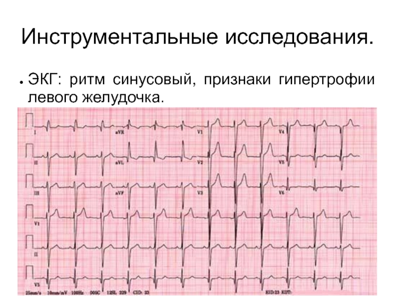 Изменения миокарда левого желудочка сердца. Гипертрофия миокарда лж на ЭКГ. ЭКГ гипертрофия желудочков гипертрофия. Гипертрофия миокарда левого желудочка на ЭКГ. ЭКГ критерии гипертрофии желудочков.