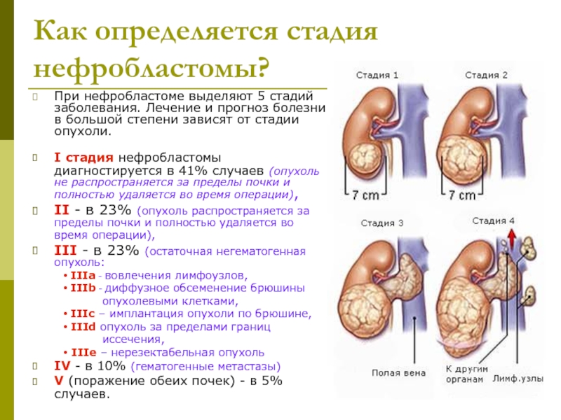 Рак почки картинки