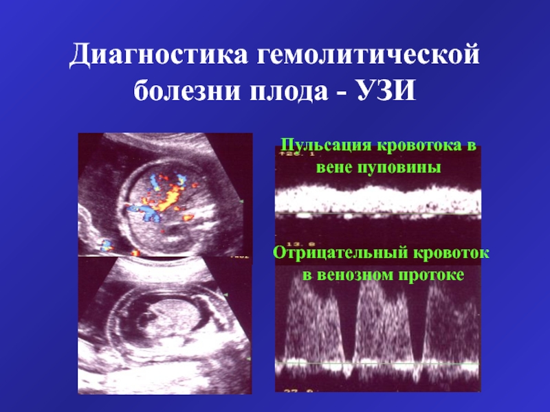 Агенезия венозного протока. Гемолитическая болезнь плода УЗИ. УЗИ при гемолитической болезни плода. Венозный проток у плода на УЗИ. Венозный кровоток у плода.