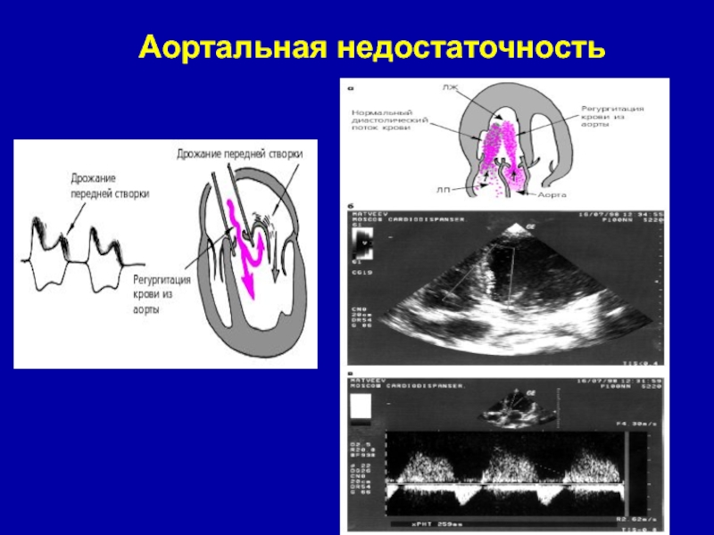 Аускультативная картина аортальной недостаточности тест