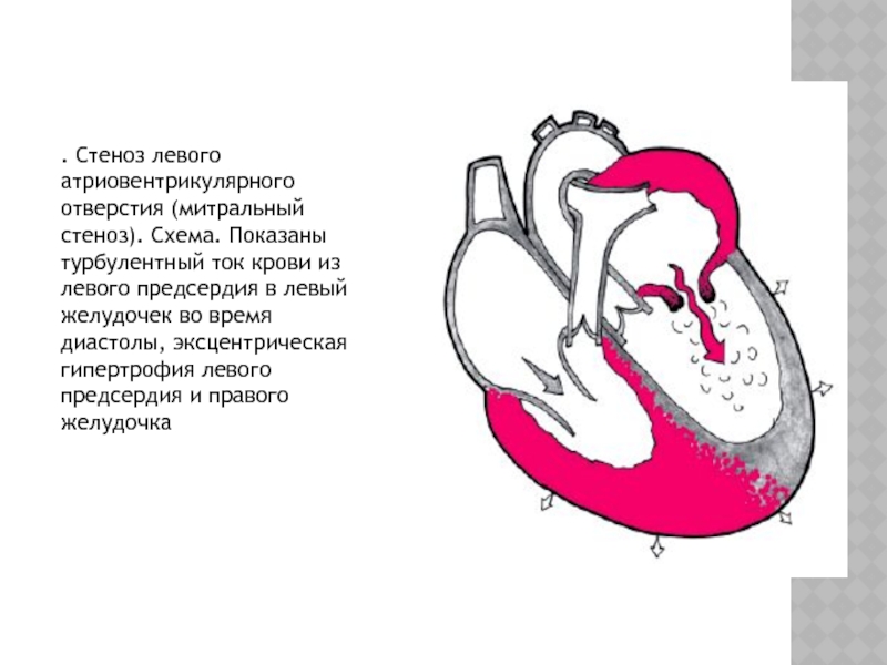 Митральная стеноз презентация